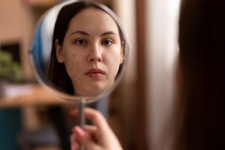 Pele acneica: rotina adequada e informação fazem diferença