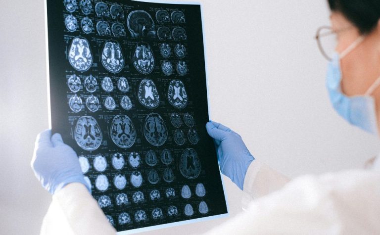 Pesquisadores desenvolvem método para prever Alzheimer antes dos primeiros sinais